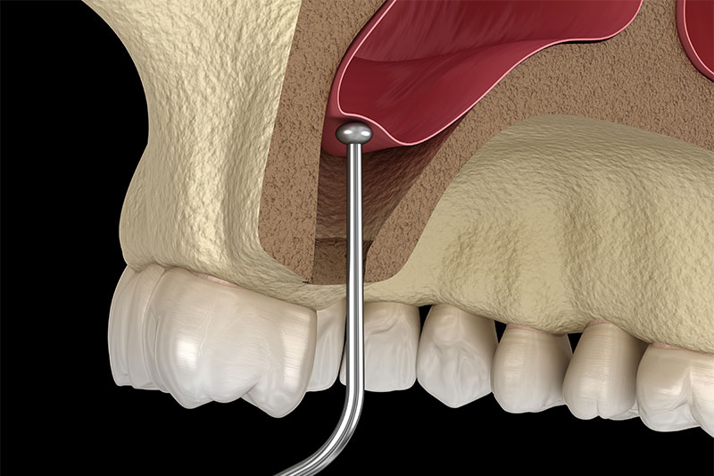 Sinus Lift in Madison