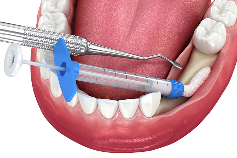 Bone Grafting in Bel Air