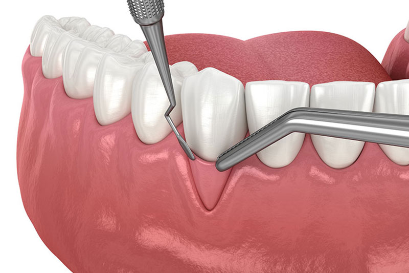 Gum Recession in Bel Air