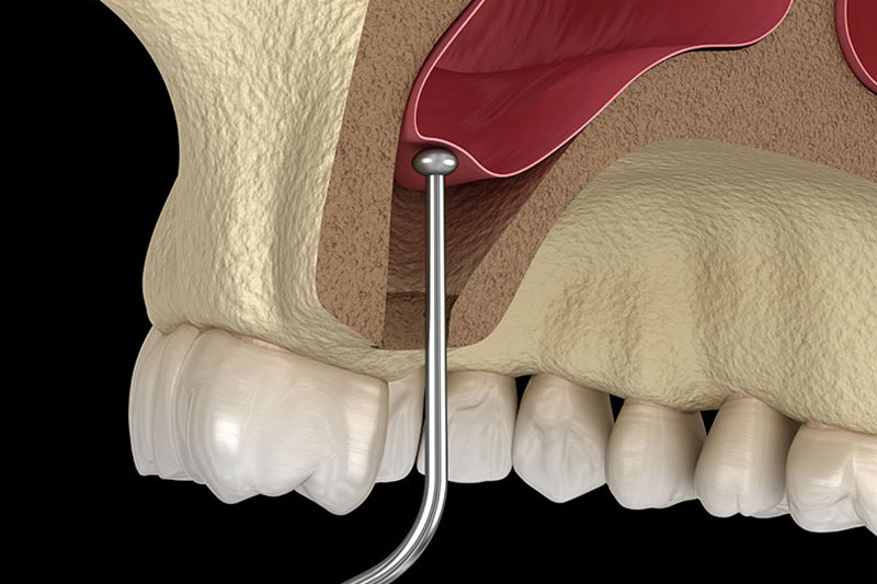 Sinus Augmentation in Bel Air