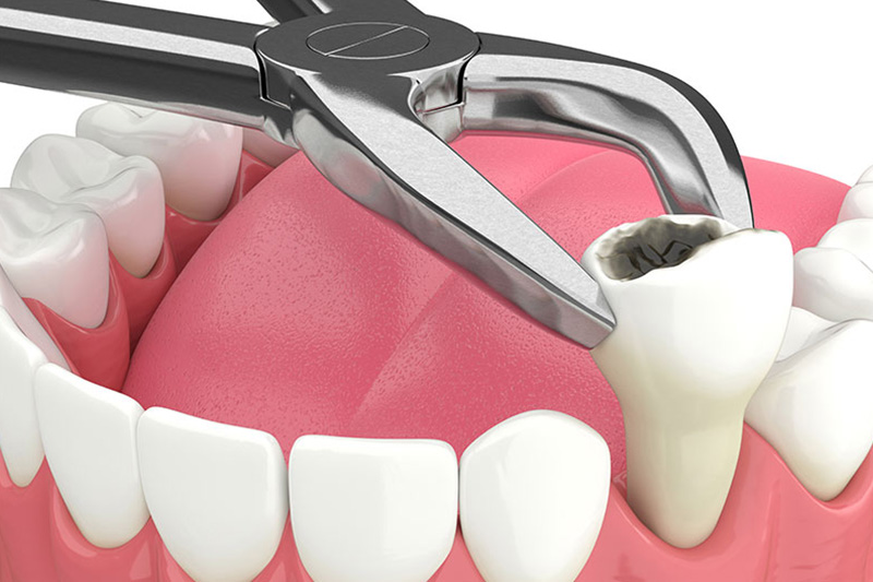 Single Tooth Extraction in Bel Air