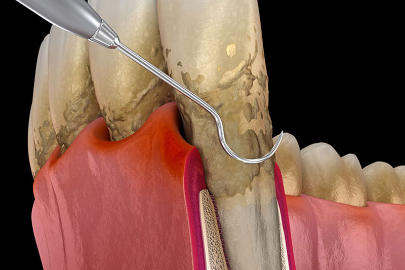 Periodontal Therapy in Cypress