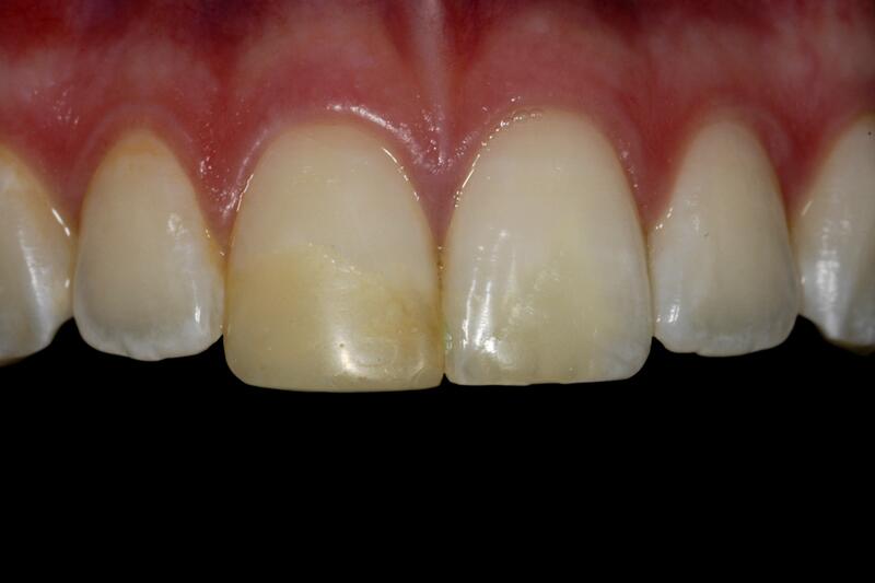 Dental Bonding Before & After