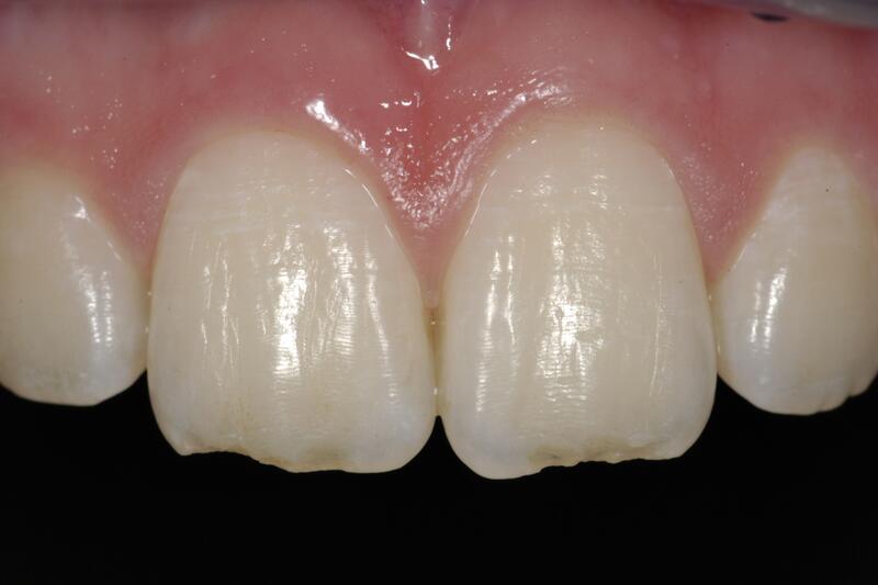 Dental Bonding Before & After