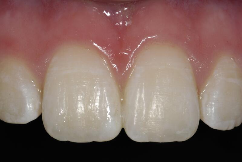 Dental Bonding Before & After