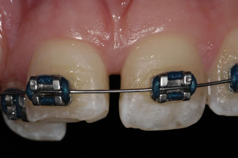 Dental Bonding Before & After