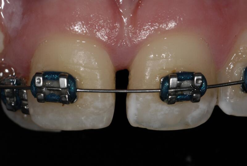 Dental Bonding Before & After