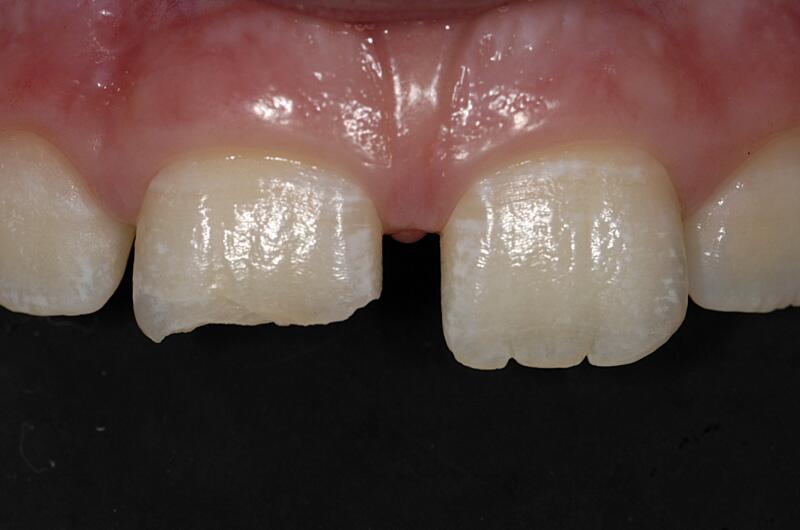 Dental Bonding Before & After