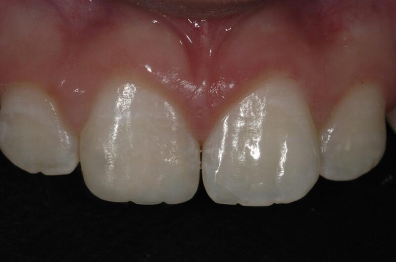 Dental Bonding Before & After