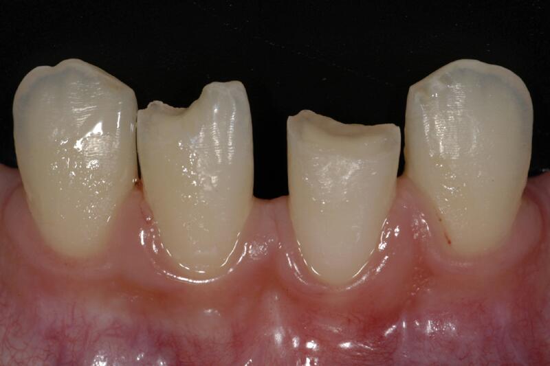 Dental Bonding Before & After