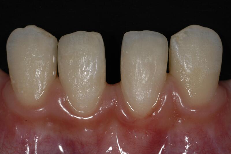 Dental Bonding Before & After