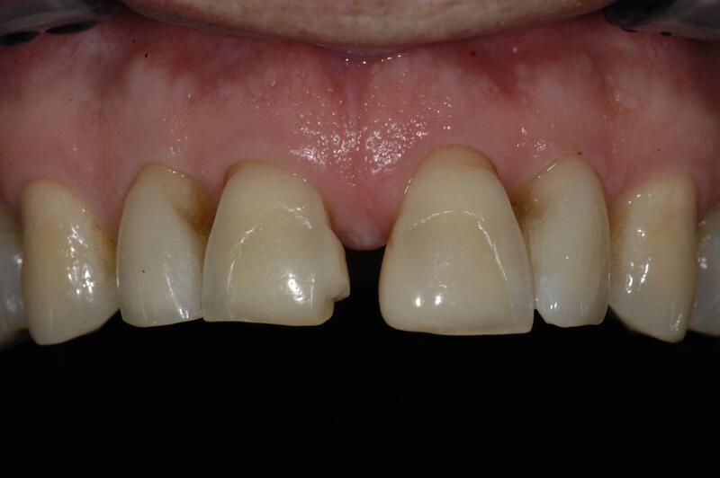 Dental Bonding Before & After