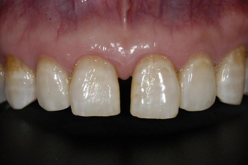 Dental Bonding Before & After