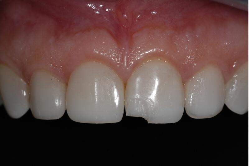 Dental Bonding Before & After