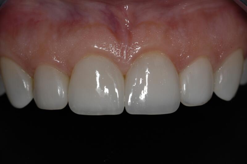 Dental Bonding Before & After