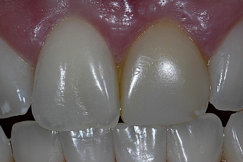 Dental Bonding Before & After