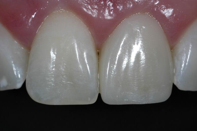 Dental Bonding Before & After