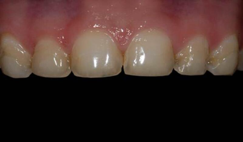 Dental Bonding Before & After