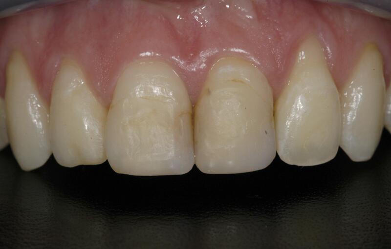 Dental Bonding Before & After