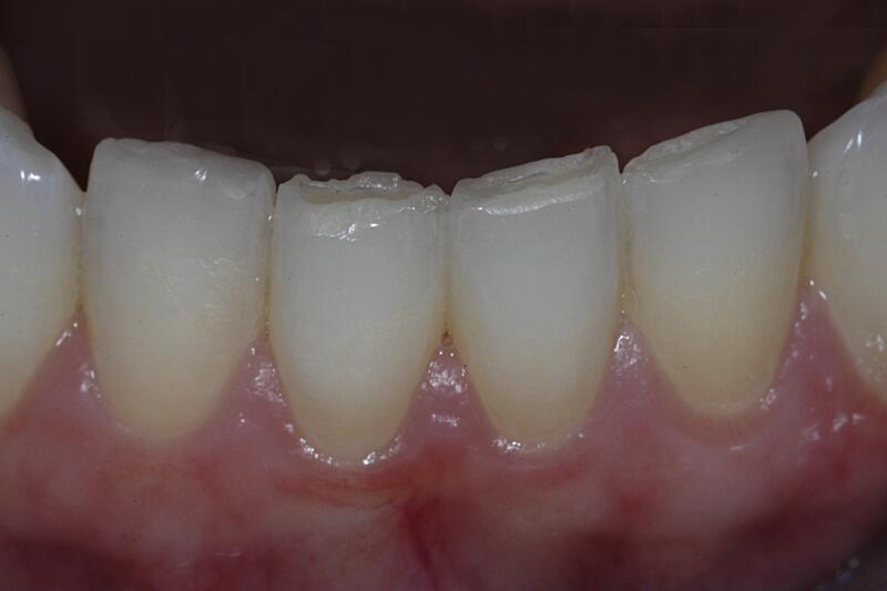 Dental Bonding Before & After