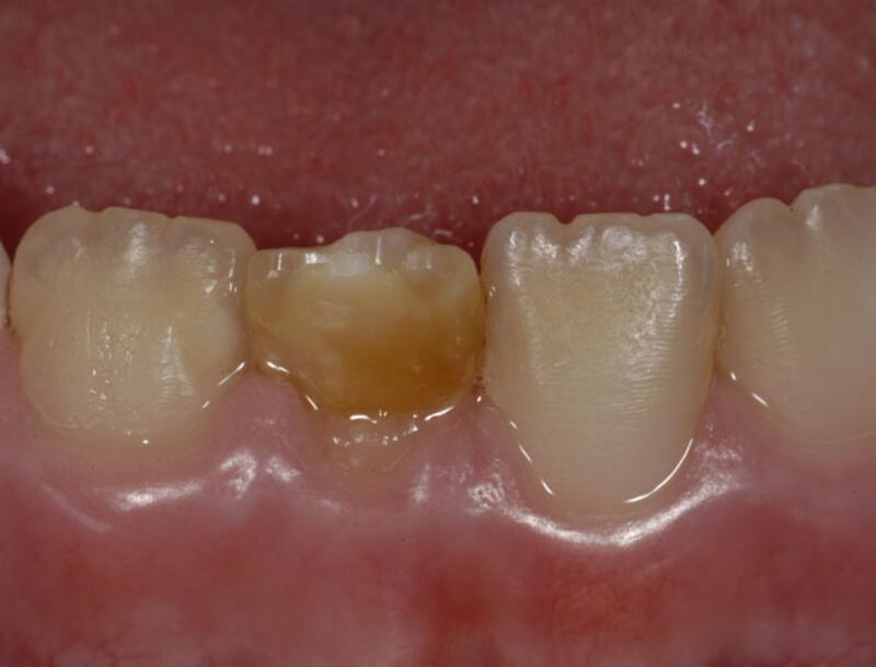 Dental Bonding Before & After