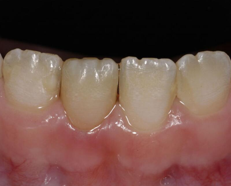 Dental Bonding Before & After