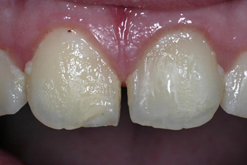 Dental Bonding Before & After