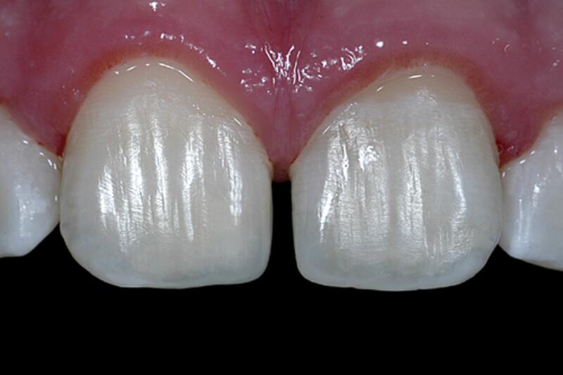 Dental Bonding Before & After