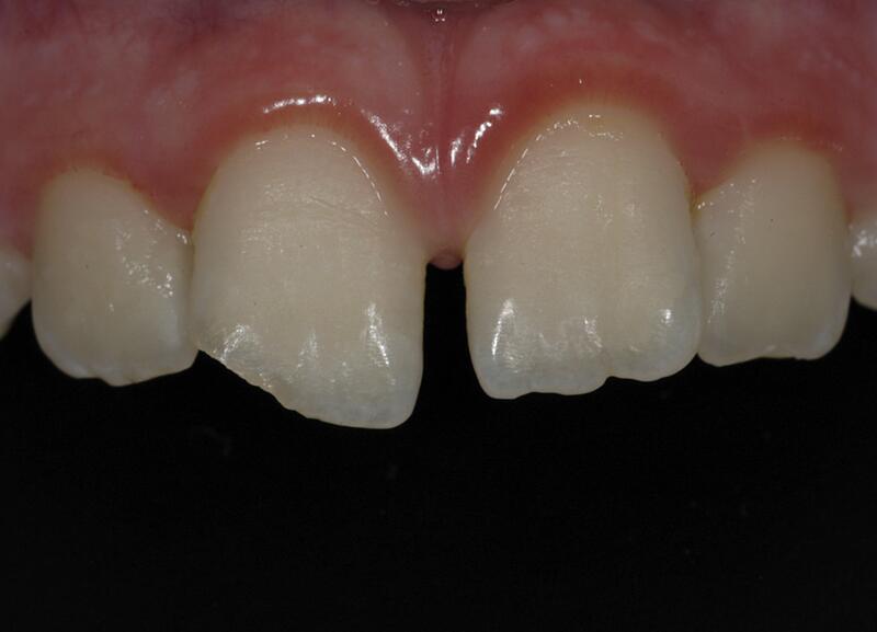 Dental Bonding Before & After