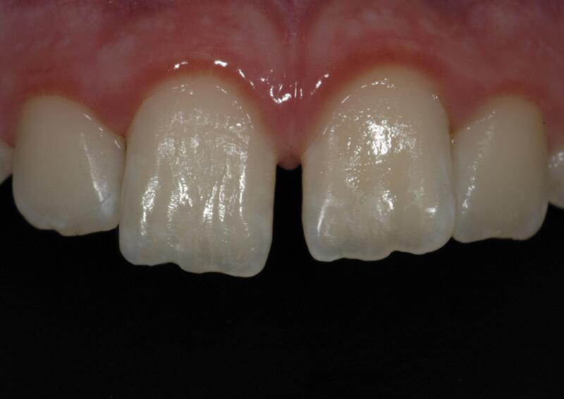 Dental Bonding Before & After