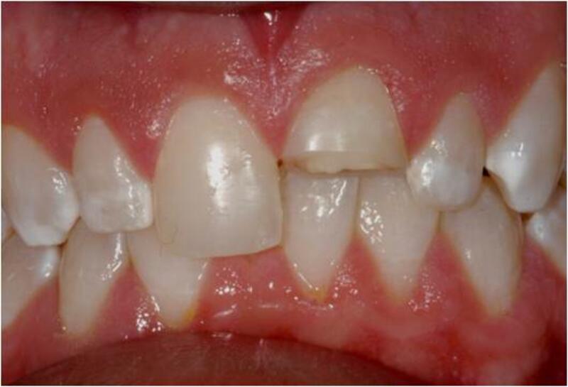 Dental Bonding Before & After