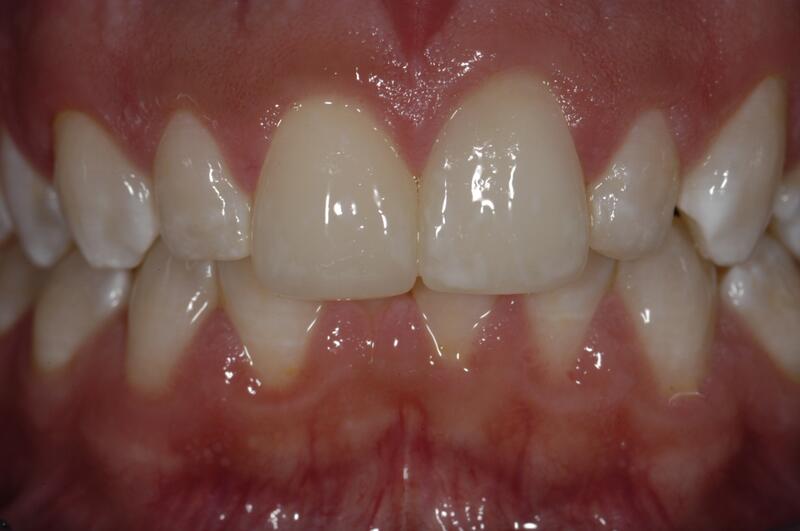 Dental Bonding Before & After