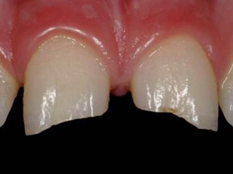 Dental Bonding Before & After