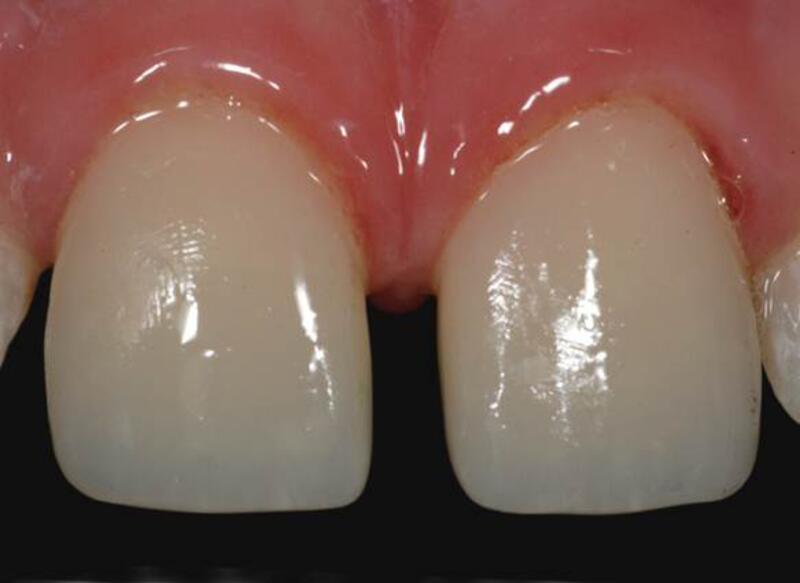 Dental Bonding Before & After