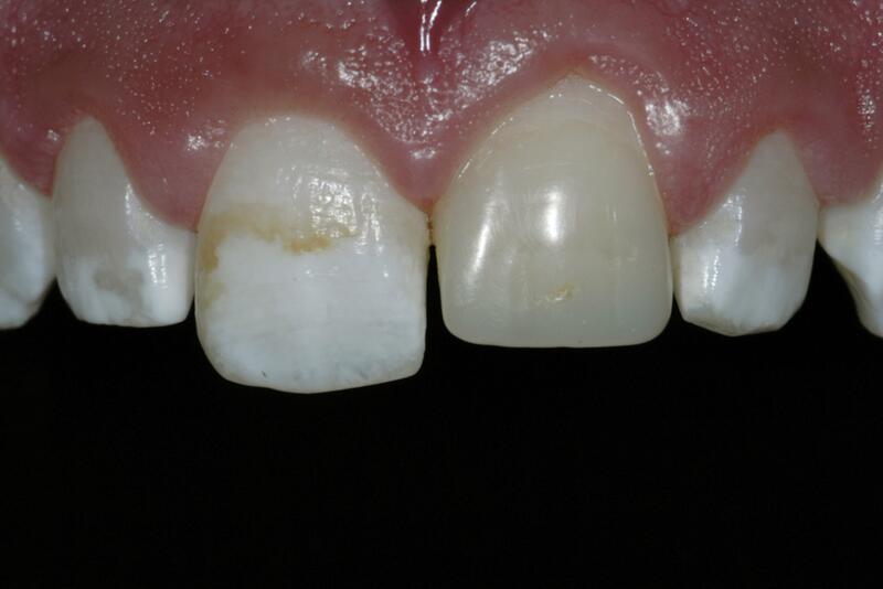 Dental Bonding Before & After