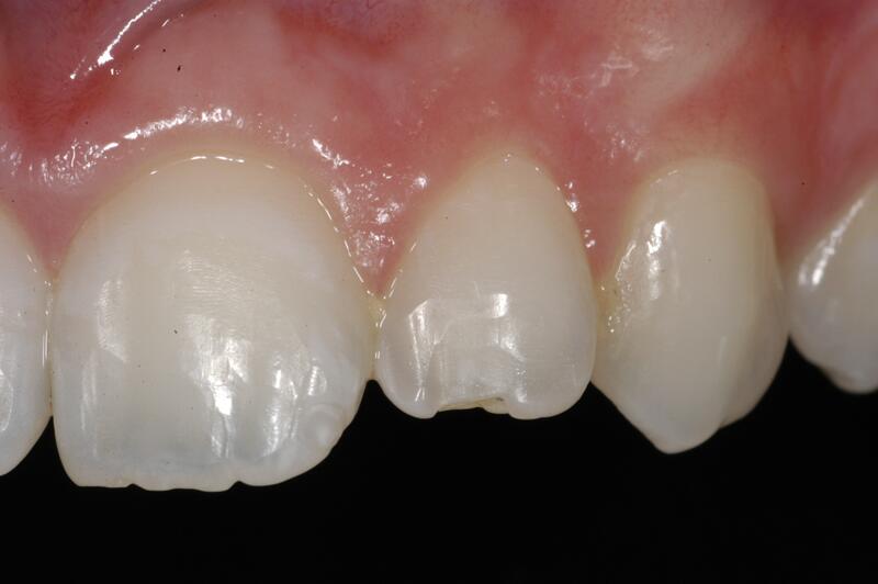 Dental Bonding Before & After