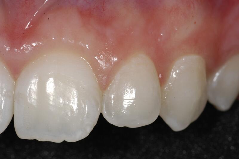 Dental Bonding Before & After