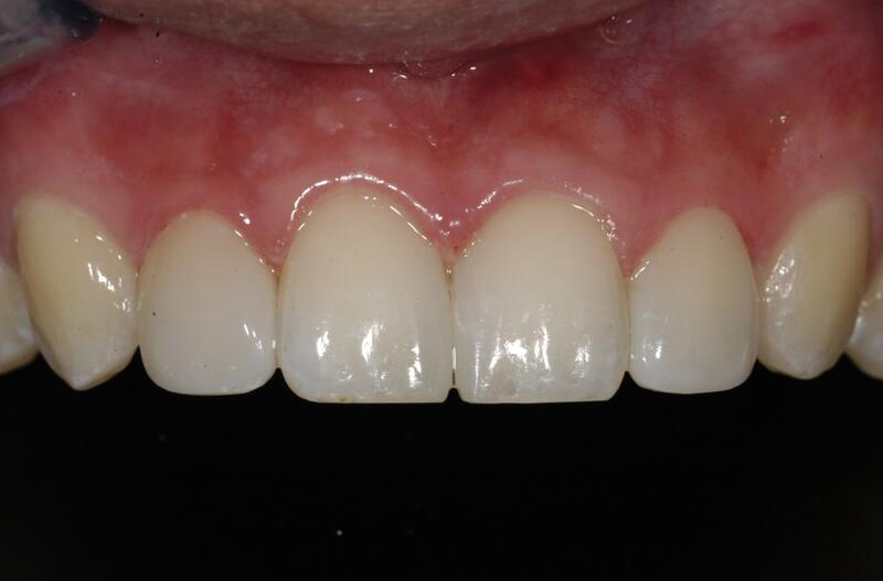 Dental Bonding Before & After