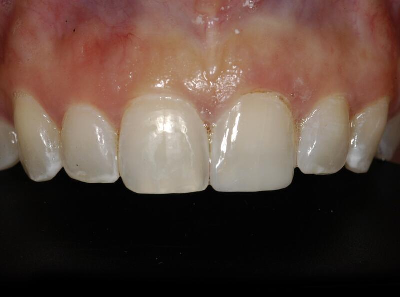 Dental Bonding Before & After