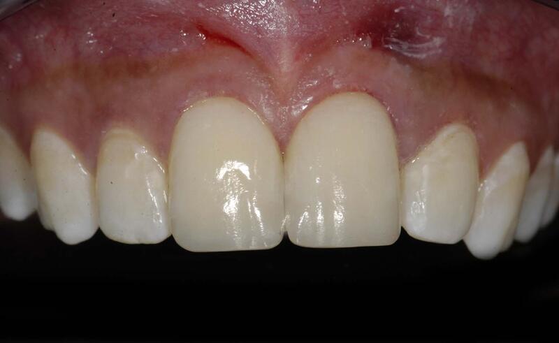 Dental Bonding Before & After