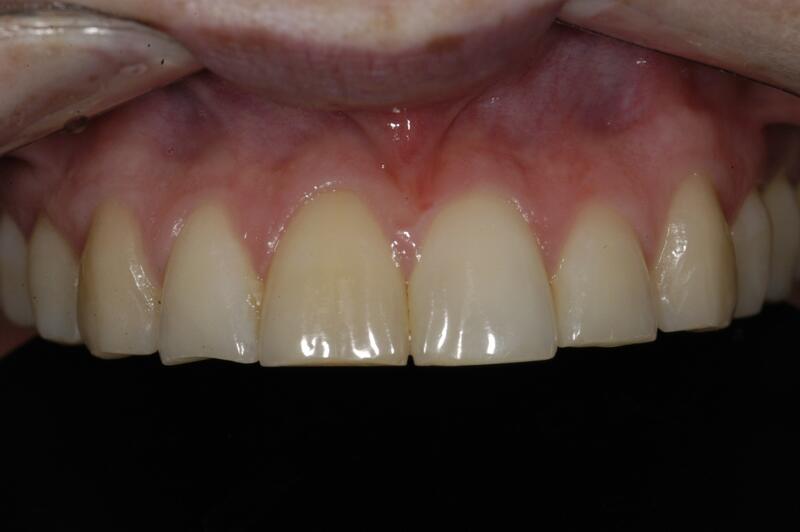 Dental Bonding Before & After