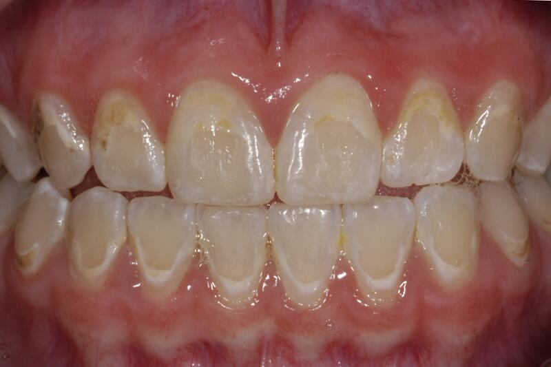 Dental Bonding Before & After