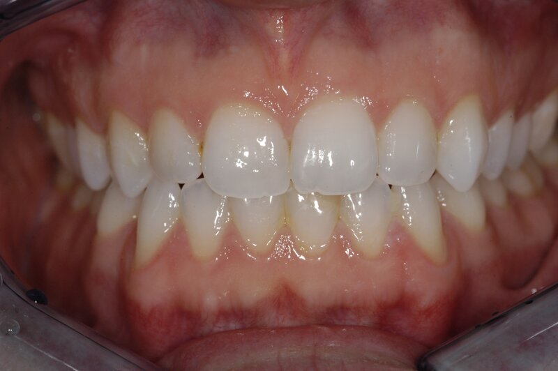 Orthodontics Invisalgn Before