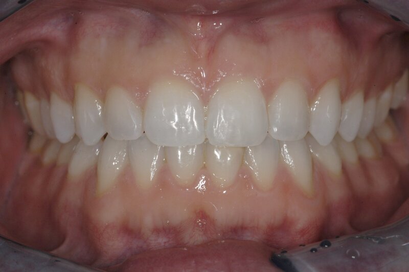 Orthodontics Invisalgn After