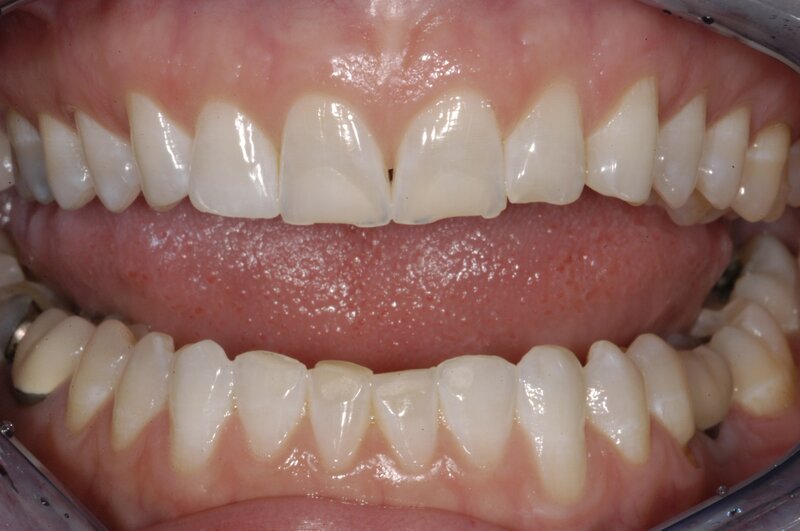 Orthodontics Invisalgn Before