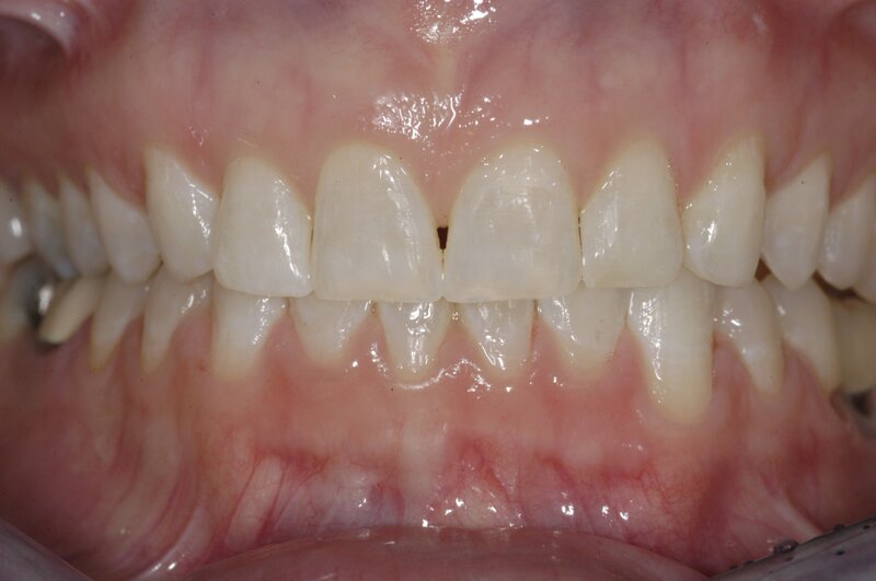 Orthodontics Invisalgn After