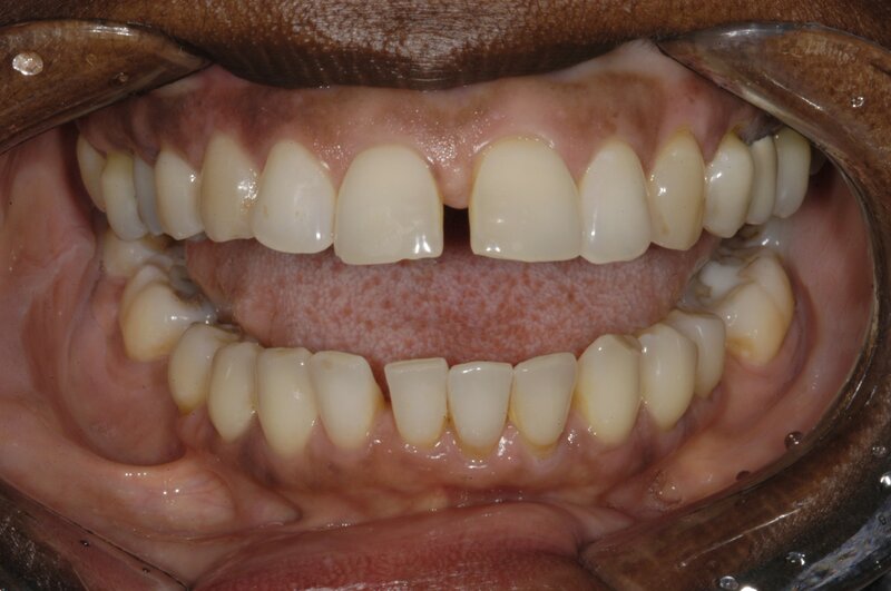 Orthodontics Invisalgn Before