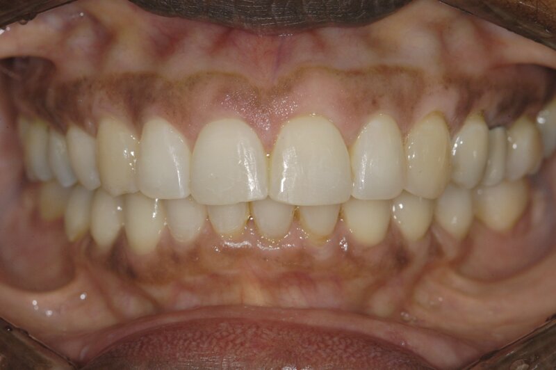 Orthodontics Invisalgn After