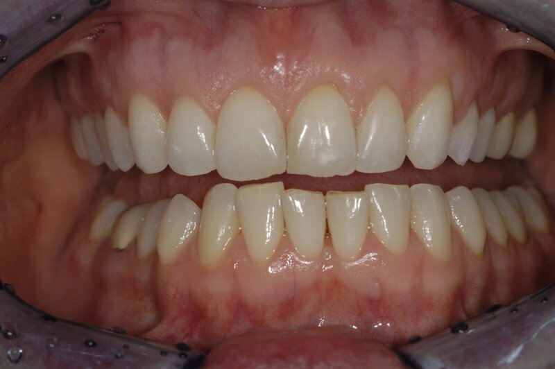 Orthodontics Invisalgn Before