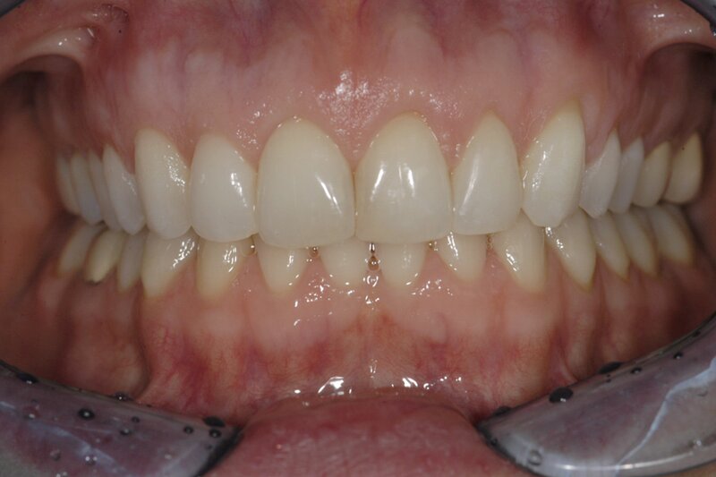 Orthodontics Invisalgn After